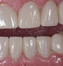 After orthodontic braces treatment