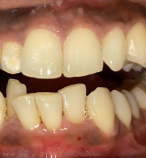 Before orthodontic treatment