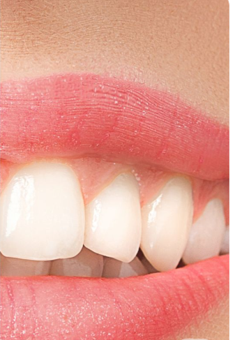 After teeth whitening treatment