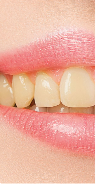 Before teeth whitening treatment