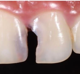 Before composite filling