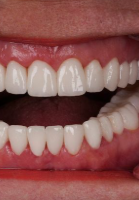 After gum treatment