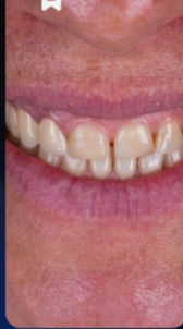 Before smile makeover treatment