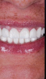 After complete smile makeover